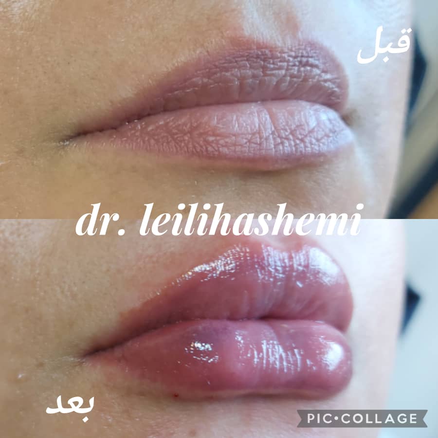 تزریق ژل لب