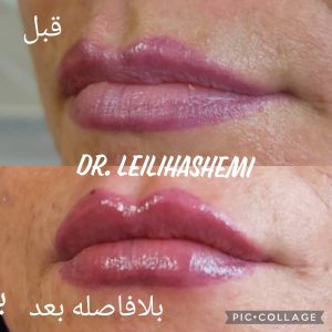 تزریق ژل لب