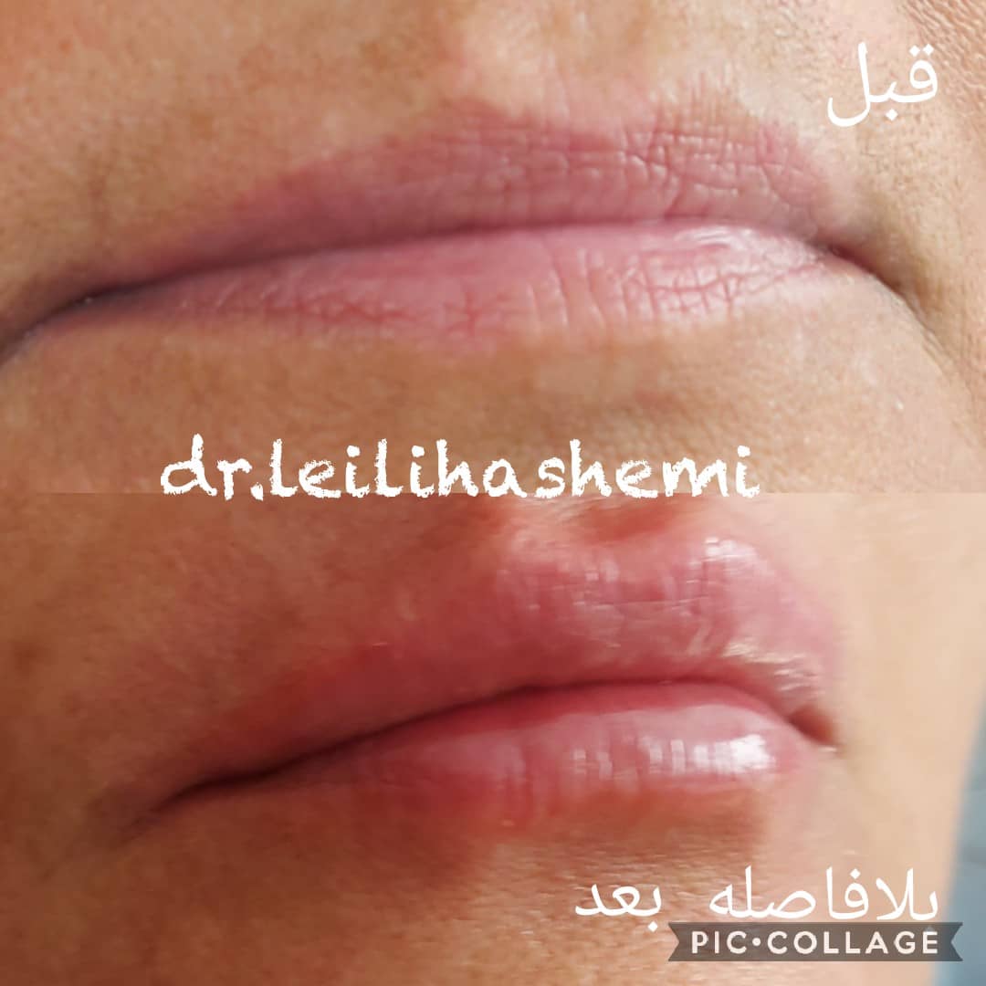 تزریق ژل لب نچرال