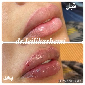 تزریق ژل لب