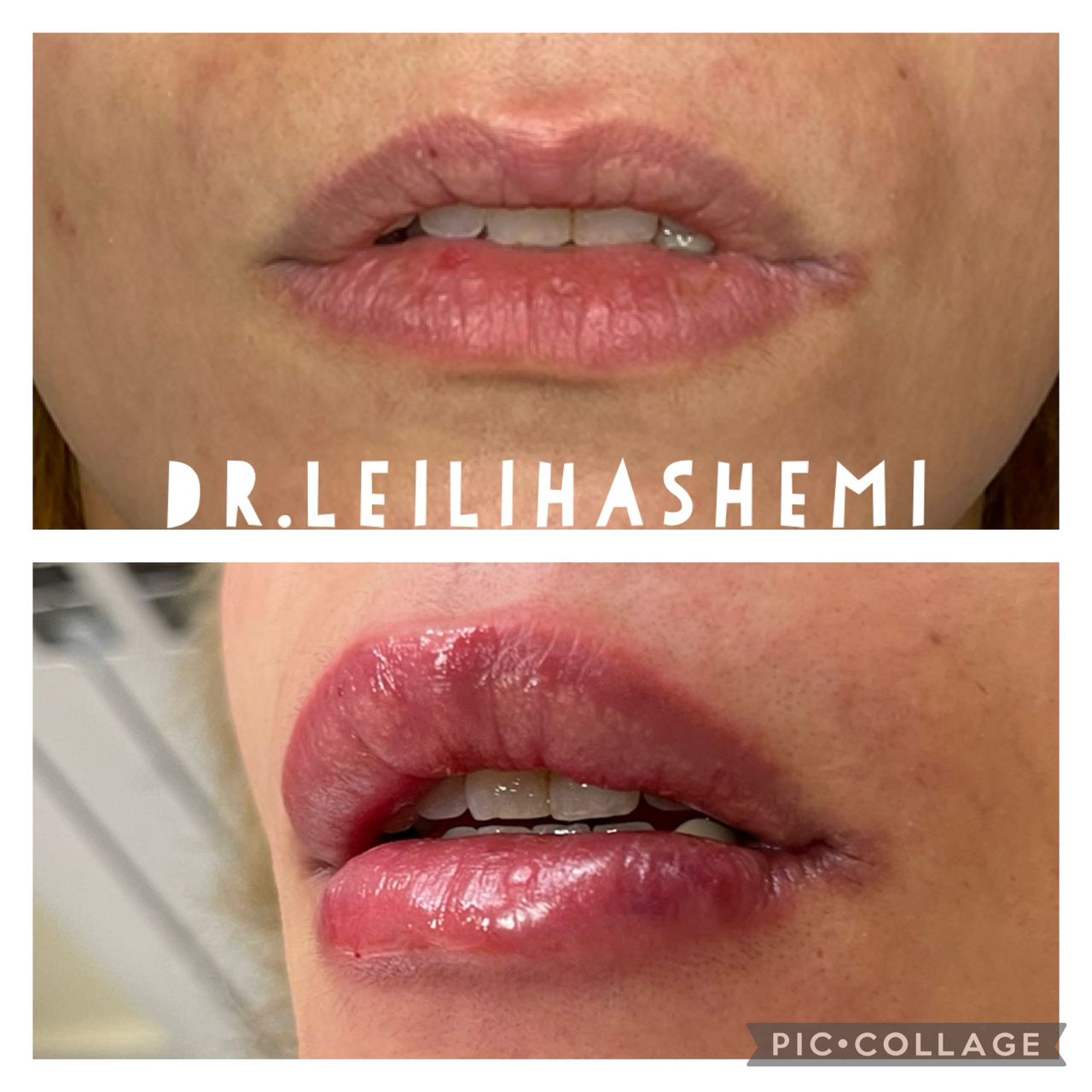 تزریق ژل لب مدل نچرال