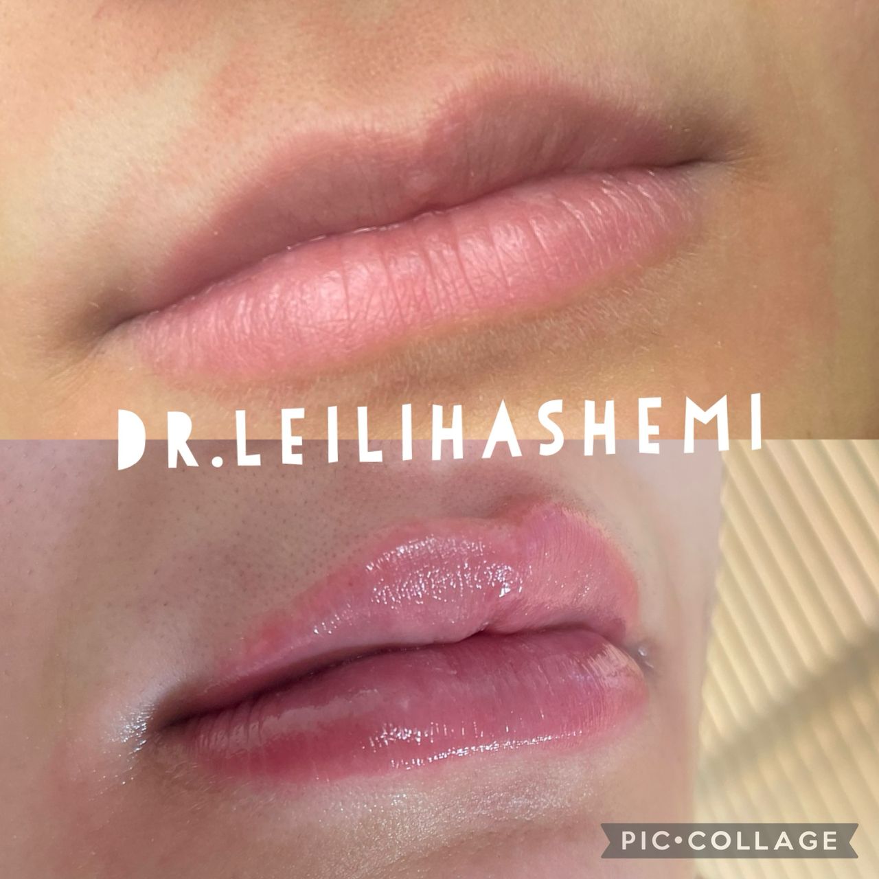 تزریق ژل لب مدل قلوه ای