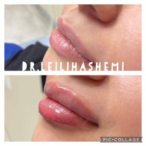 تزریق ژل لب مدل روسی