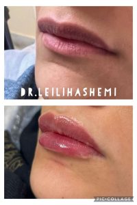 تزریق ژل لب مدل روسی در تهران