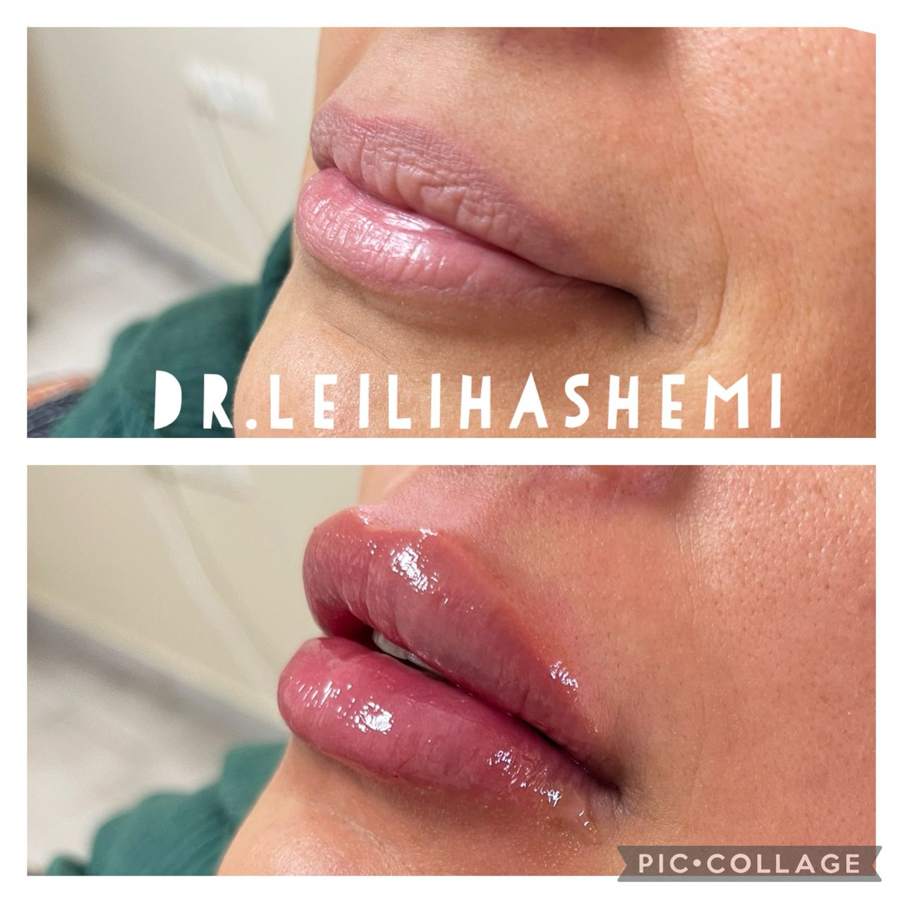 تزریق ژل لب مدل روسی در کلینیک تهران