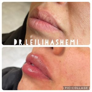 تزریق ژل لب روسی