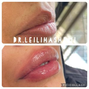 تزریق ژل لب قلوه ای