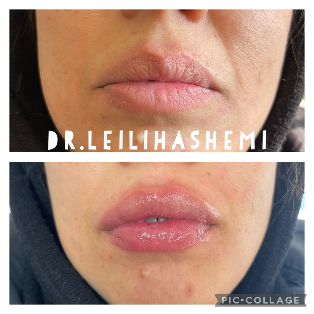 تزریق ژل لب خط دار