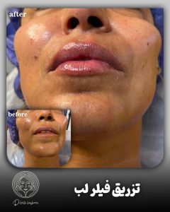 تزریق فیلر لب طبیعی