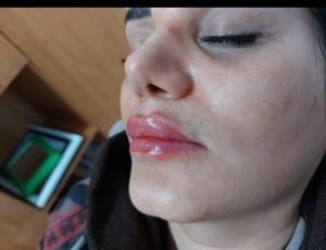 تزریق ژل لب روسی