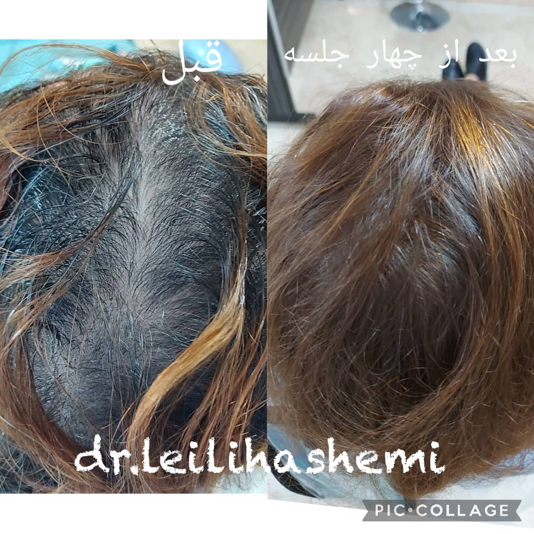 مزوتراپی مو و صورت در تهران