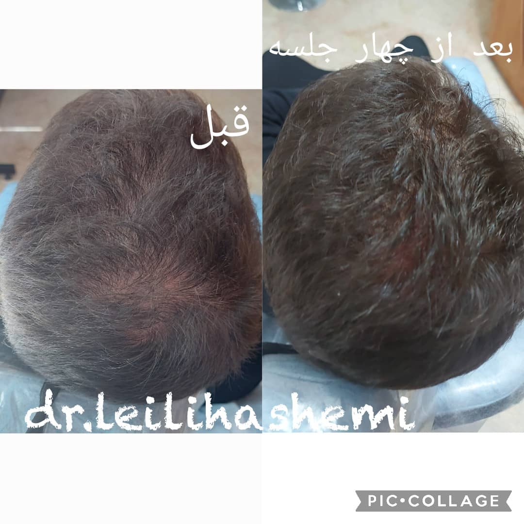 مزوتراپی مو در تهران