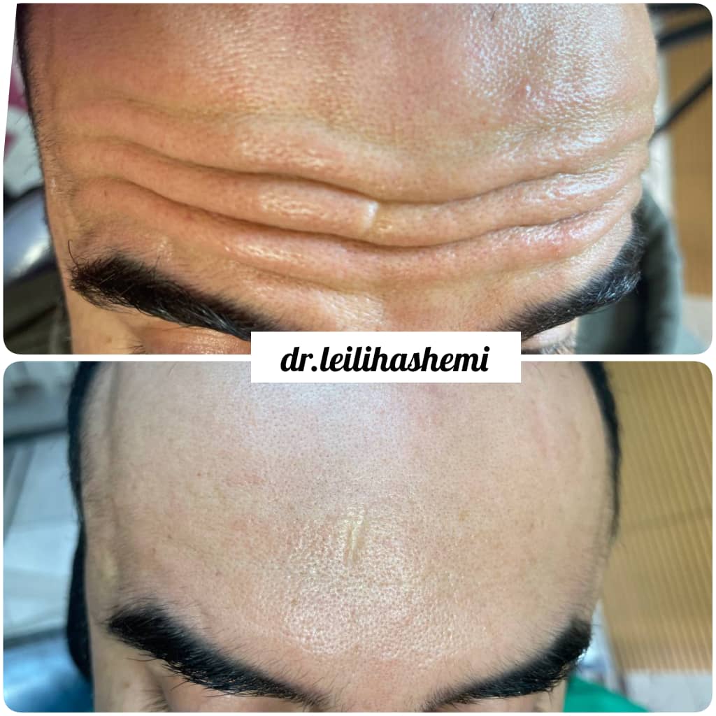 تزریق بوتاکس