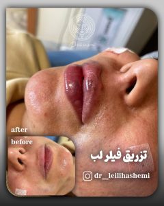 تزریق فیلر لب روسی