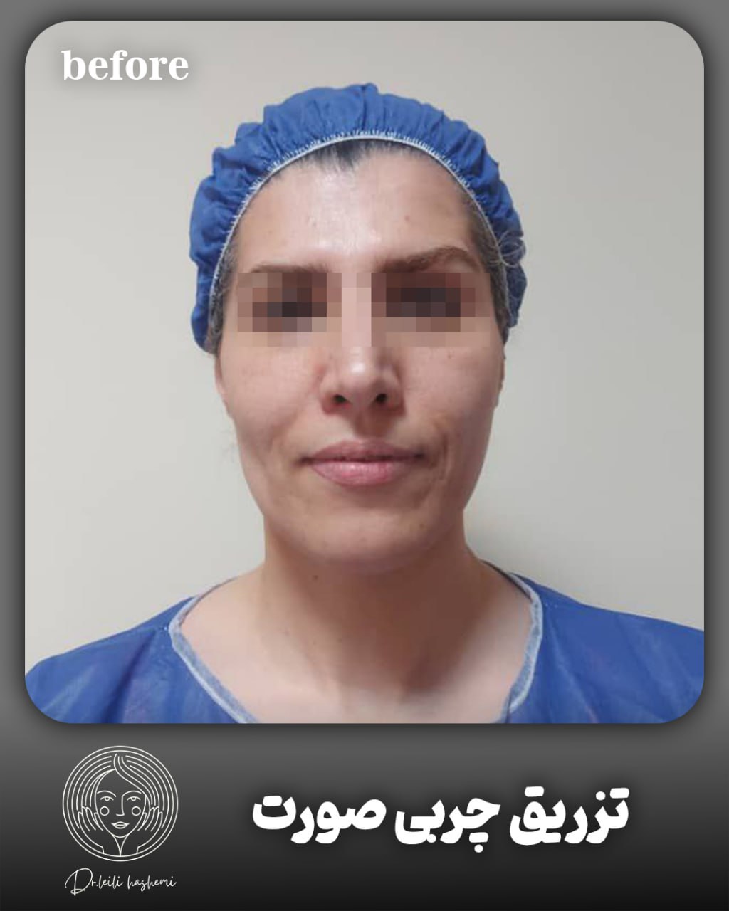 تزریق چربی صورت