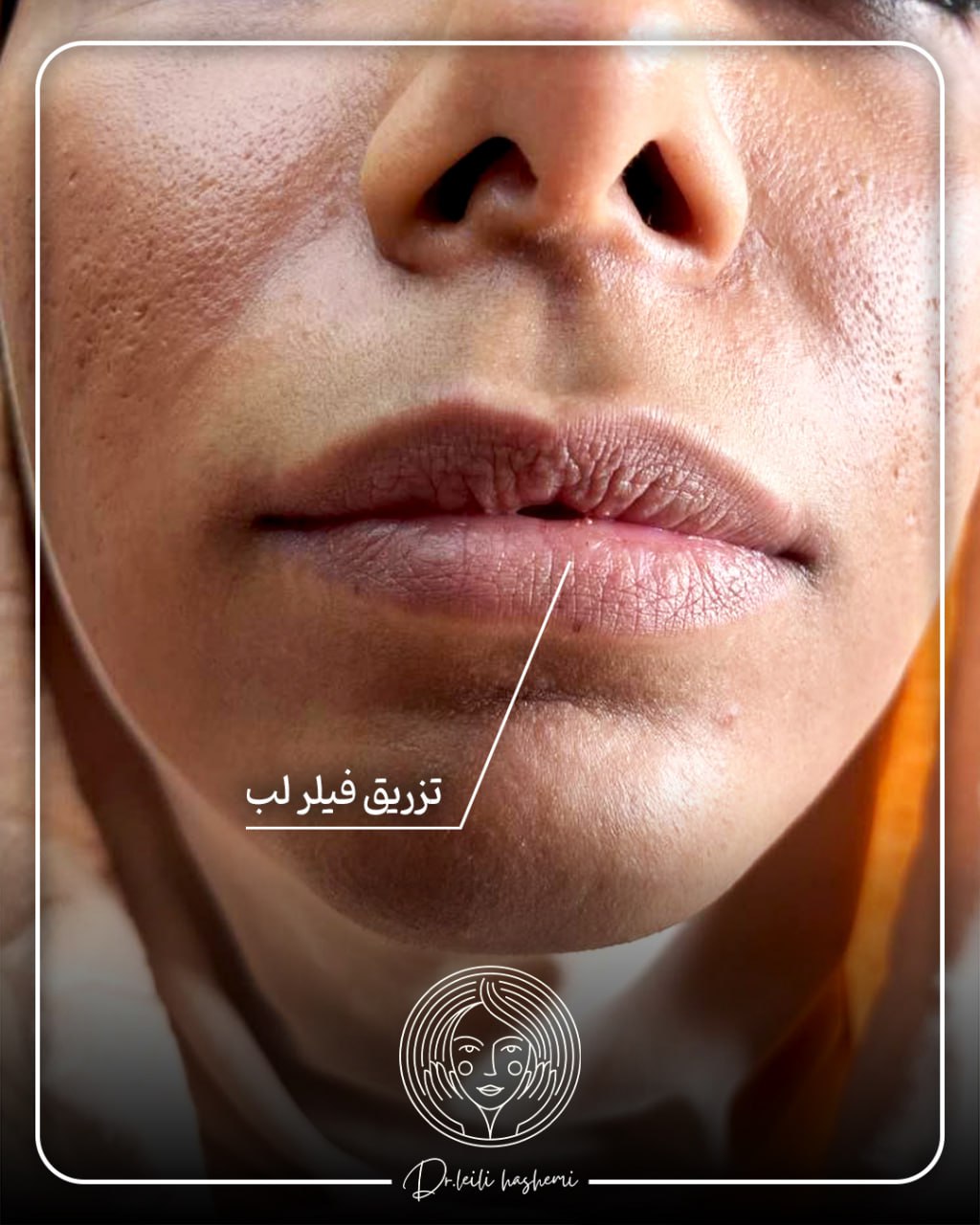 تزریق فیلر لب