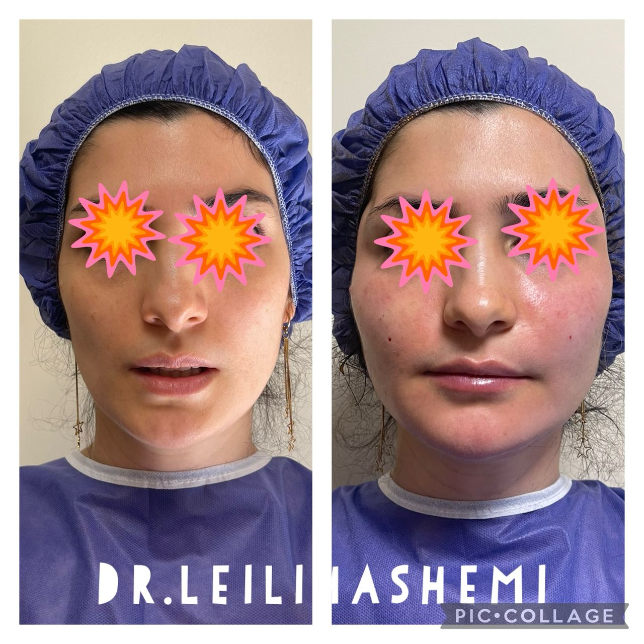 تزریق چربی صورت