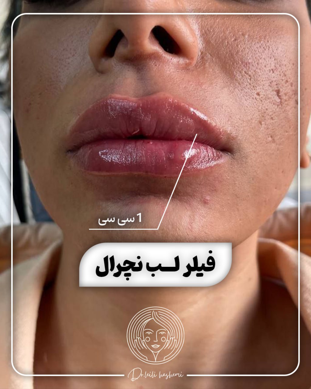 تزریق فیلر لب نچرال