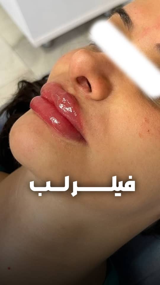 تزریق فیلر لب روسی