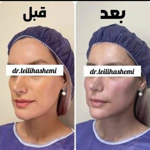 تزریق چربی صورت در کلینیک دکتر هاشمی