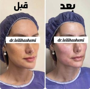 تزریق چربی صورت