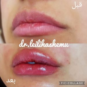 تزریق ژل لب