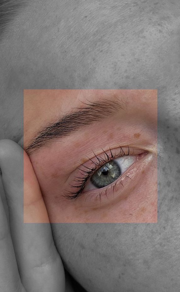 لیفت چشم با نخ