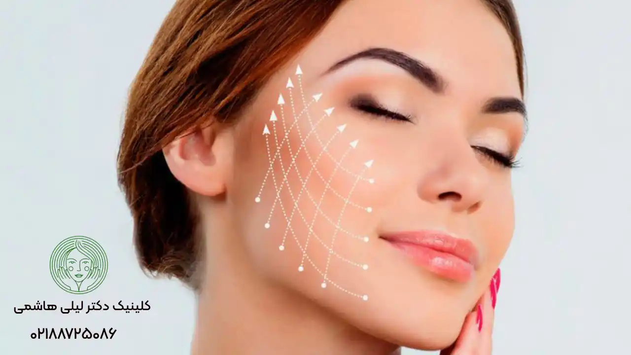 آشنای با انواع نخ لیفت