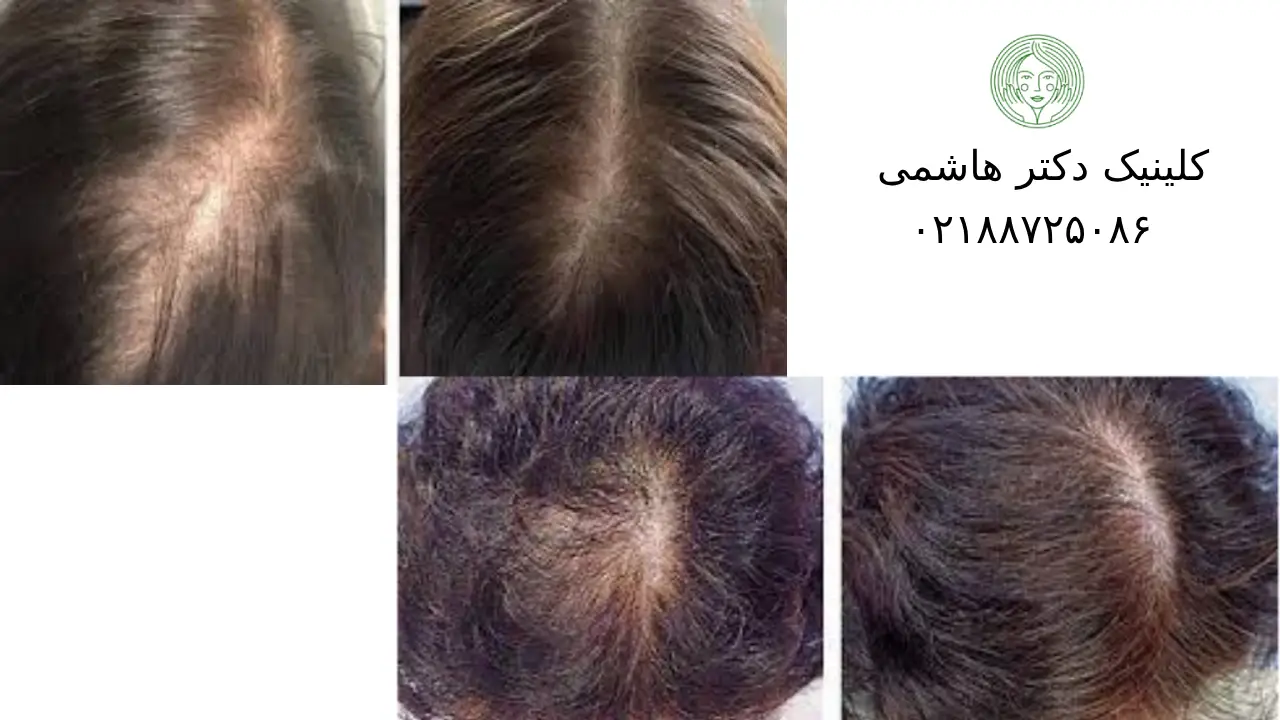 کاندید های مناسب مزوتراپی