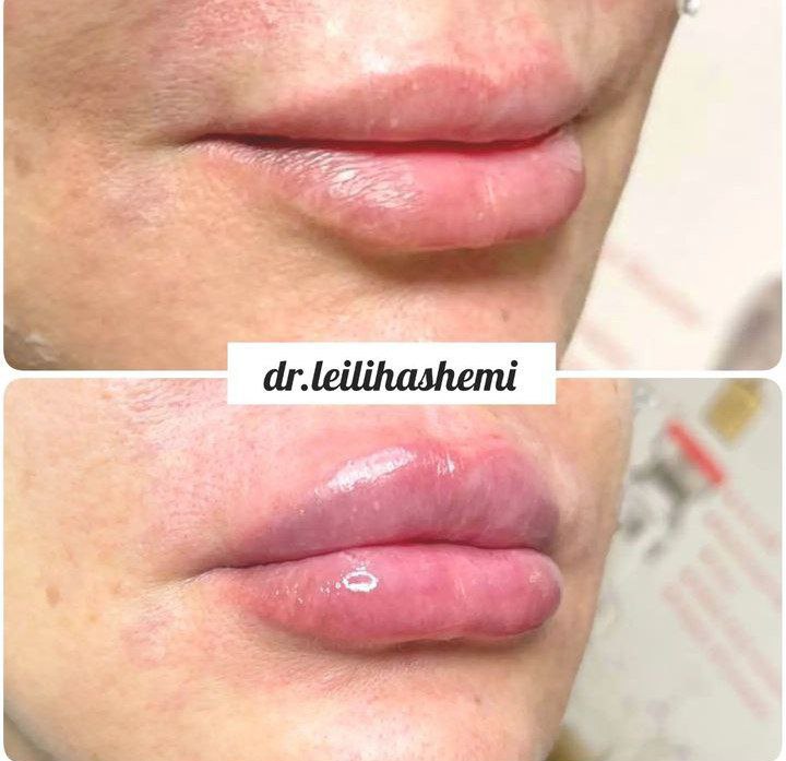 عکس ژل لب کدل قلوه ای