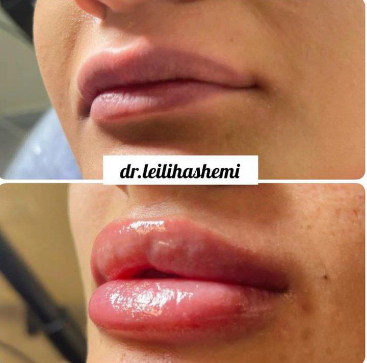 عکس ژل لب قلوه ای