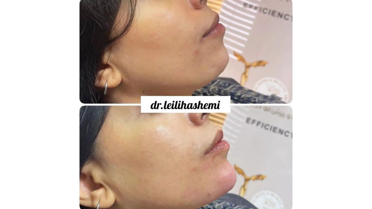 تزریق فیلر چانه 