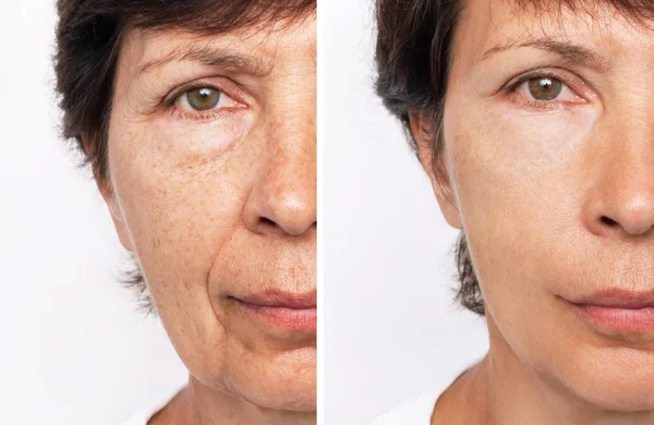 در کدام بخش های بدن می شود پروفایلو تزریق کرد؟