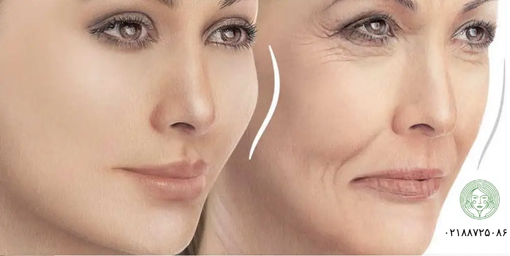 چند روز بعد از تزریق چربی صورت طبیعی میشود؟
