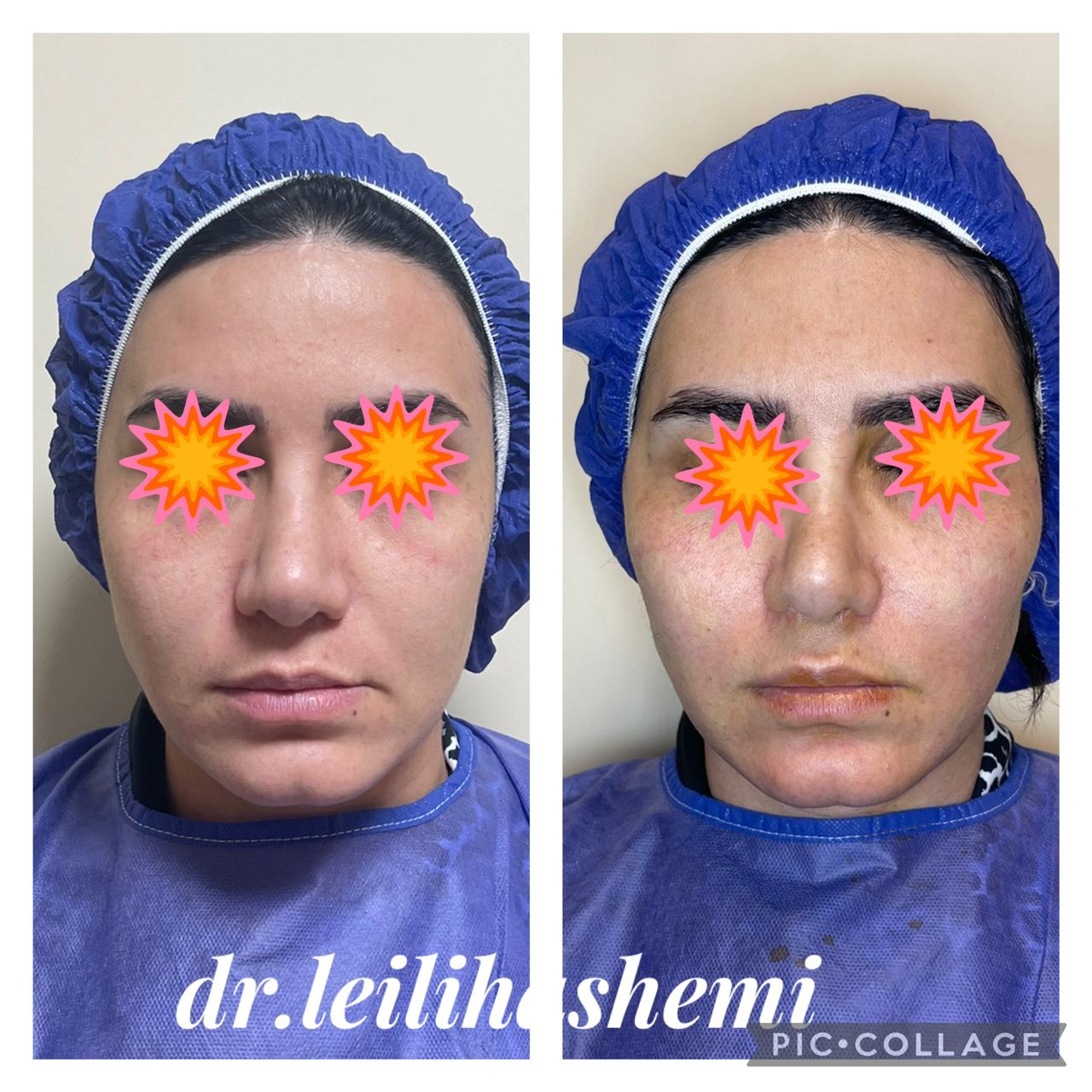 آیا تزریق چربی به صورت باعث افتادگی پوست میشود؟+ دلیل افتادگی صورت و عوارض تزریق