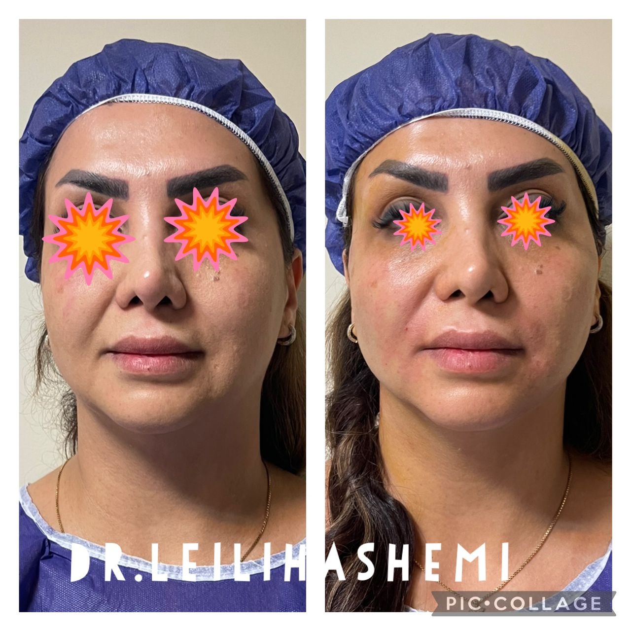 افتادگی صورت بعد از تزریق چربی