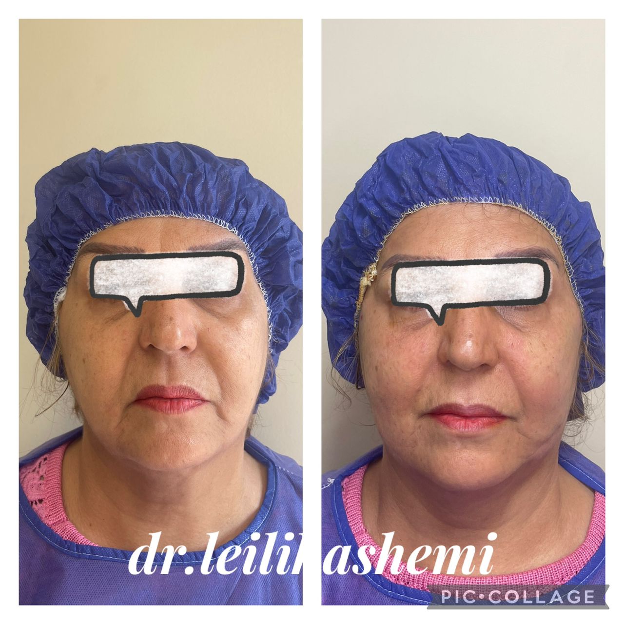 مراقبتهای قبل و بعد از تزریق چربی برای جلوگیری از افتادگی پوست