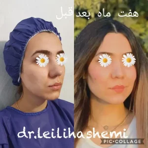 بهترین کلینیک تزریق چربی در تهران