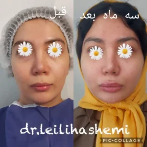 بهترین دکتر تزریق چربی