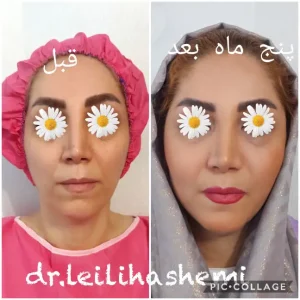 تزریق چربی در تهران