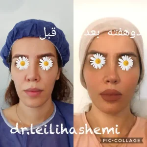 بهترین دکتر تزریق چربی در تهران