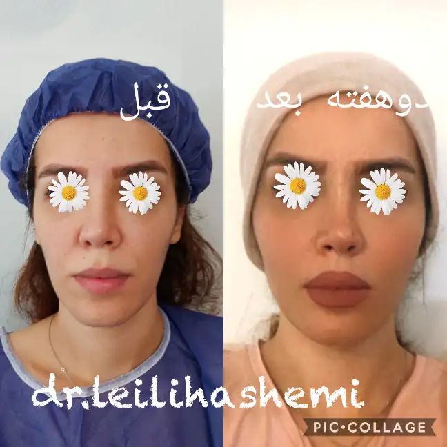 بهترین دکتر تزریق چربی در تهران