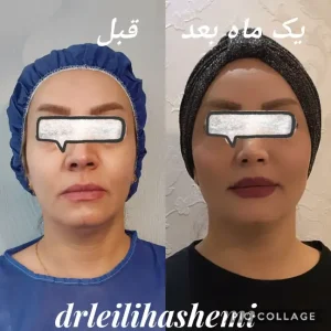 هزینه تزریق چربی در تهران