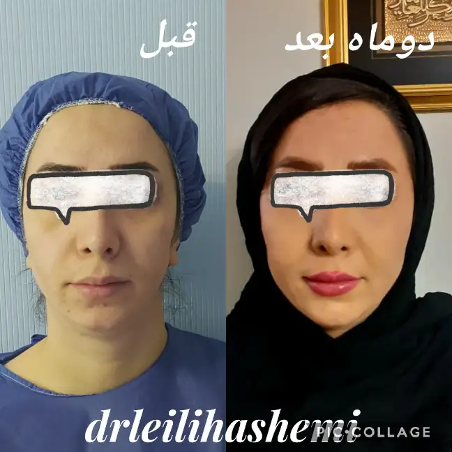 تزریق چربی به صورت در تهران