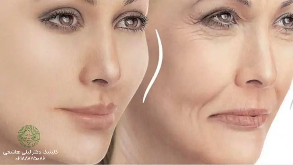 افتادگی صورت بعد از تزریق چربی