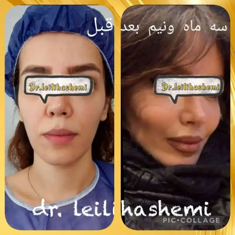 نمونه کار تزریق چربی به صورت لاغر و استخوانی دکتر لیلی هاشمی