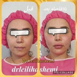 چه عواملی بر دوام تزریق چربی تاثیر دارد؟