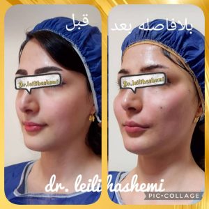 چطور ماندگاری تزریق چربی را بیشتر کنیم؟