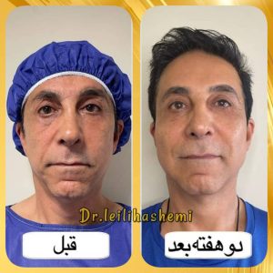 تزریق چربی به صورت و عوارض تزریق چربی