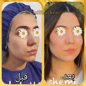 تزریق چربی با روش کلاسیک یا نانوفت